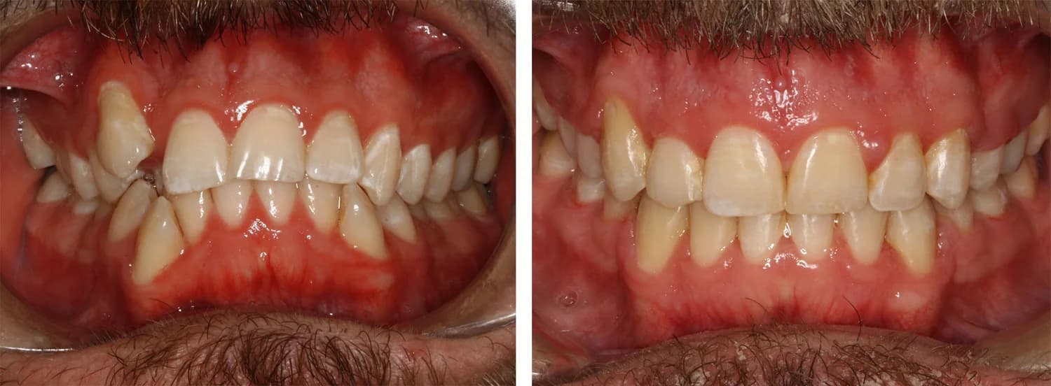 Case 1 — before and after orthodontic treatment