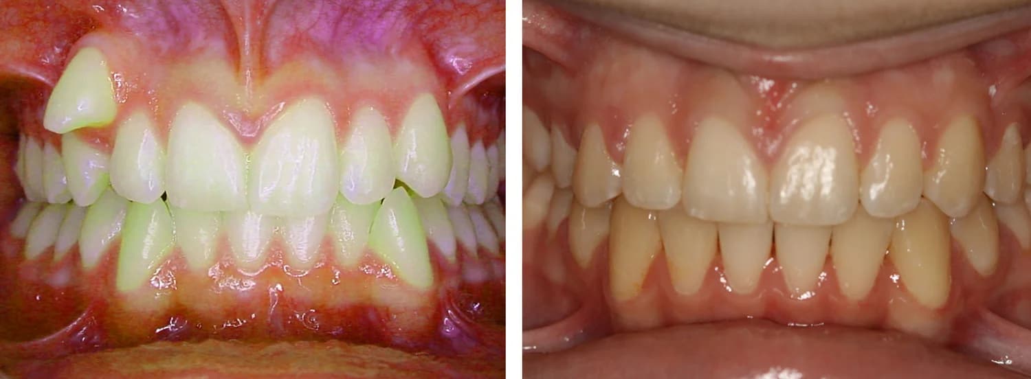 Case 2 — before and after orthodontic treatment