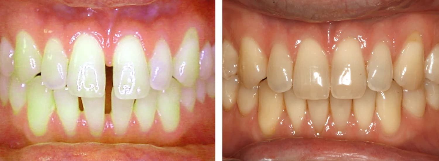 Case 3 — before and after orthodontic treatment