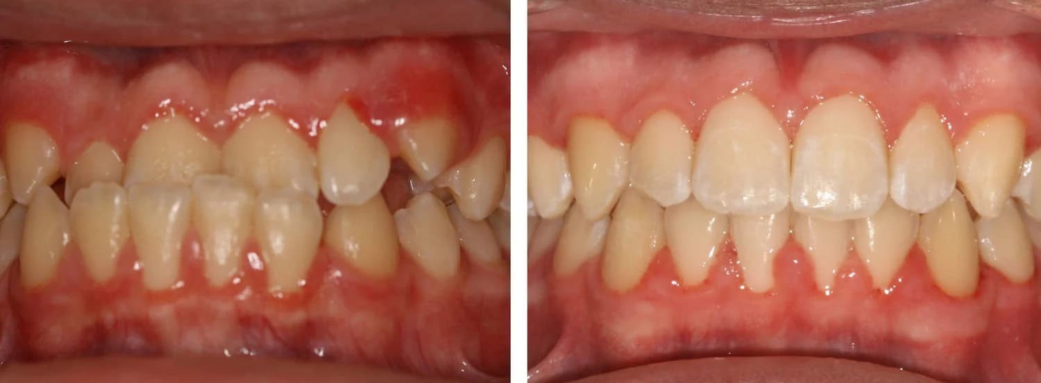 Case 4 — before and after orthodontic treatment