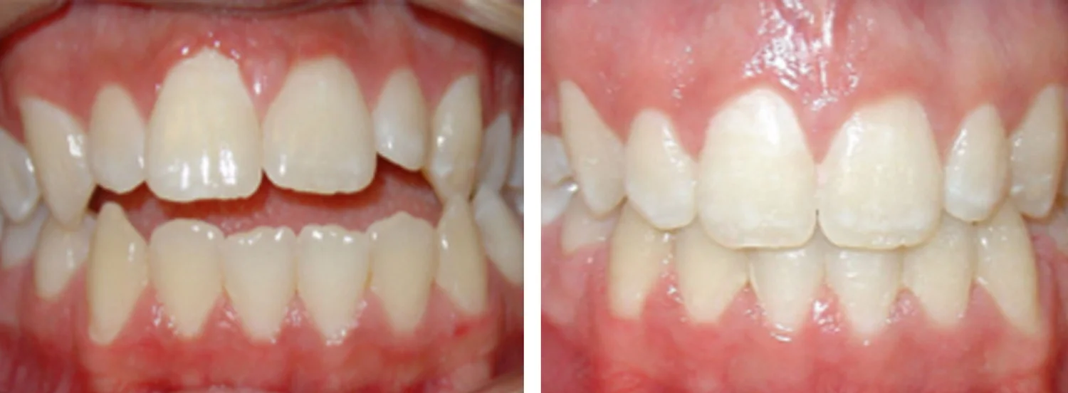 Case 5 — before and after orthodontic treatment