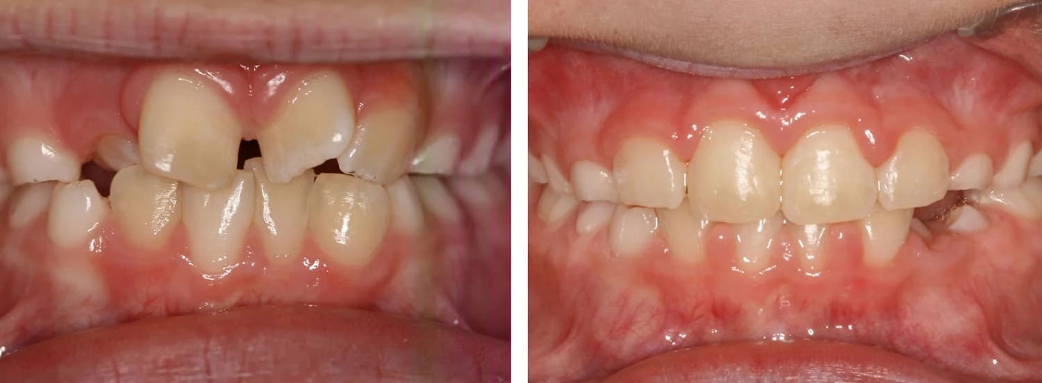 Case 6 — before and after orthodontic treatment